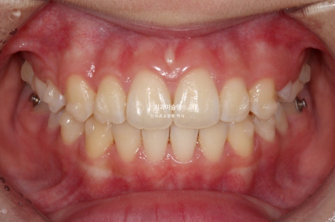 돌출입 비발치 어린이 교정 입술부전증 호두주름 호두턱 토끼이빨 인비절라인퍼스트 관련 이미지 8