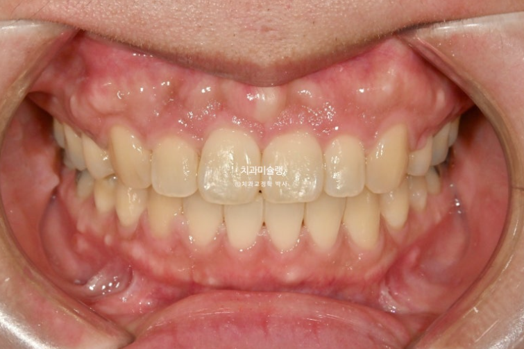 Extraction Orthodontics with Clippy-C for Protruding Mouth, Gum Smile, Gummy Smile Correction, and Treatment for a Recessed Chin image 10