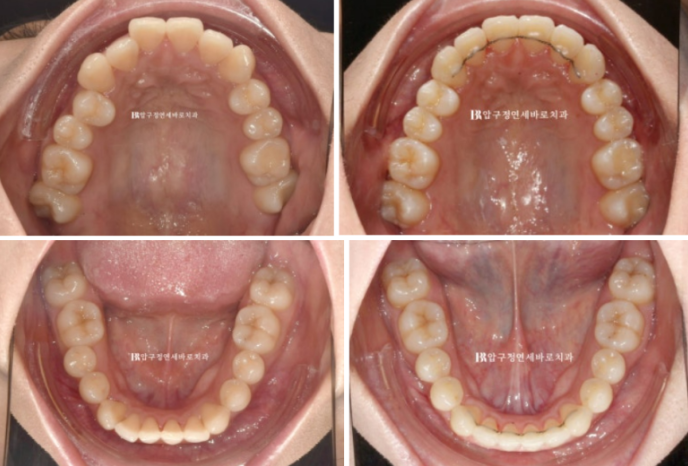 Invisalign Lite Treatment for Crossbite, Rabbit Teeth, and Protruding Front Teeth Correction image 10