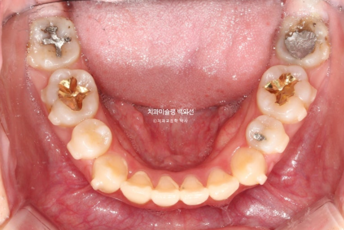 돌출입 인비절라인 발치교정 거미스마일 잇몸미소 잇몸돌출 입술부전증 무턱 재교정 관련 이미지 13