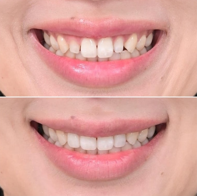 왜소치 반점치 (반상치)가 있는 경우 무삭제 라미네이트 치료 관련 이미지 9