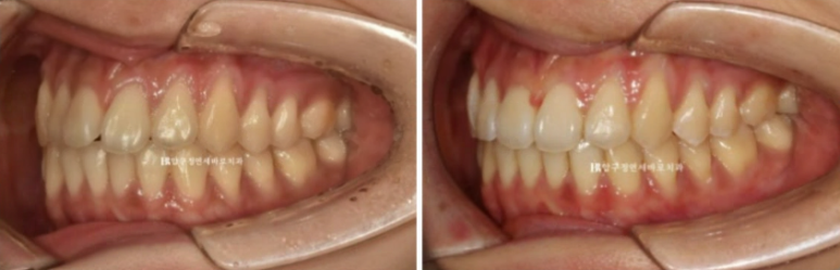 인비절라인 익스프레스 토끼이빨 앞니교정 ? 관련 이미지 12