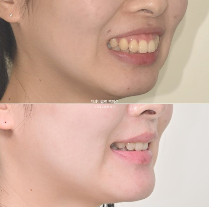 돌출입 인비절라인 발치교정 거미스마일 잇몸미소 잇몸돌출 입술부전증 무턱 재교정 관련 이미지 24