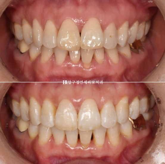 50대 중년교정 인비절라인 라이트 나비치아 교정 앞니 교정 후기 관련 이미지 13