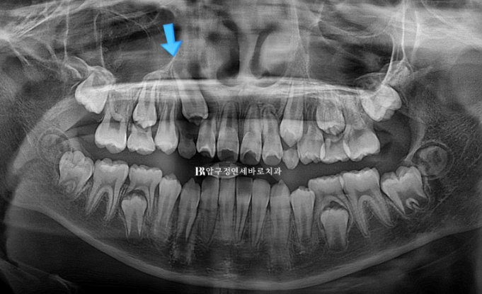 Simultaneous Arch Expansion and Teeth Alignment for Elementary School Children with Invisalign｜Invisalign First image 3