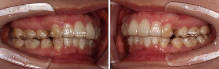 돌출입 덧니 발치 교정 인비절라인 교정 후기 관련 이미지 9