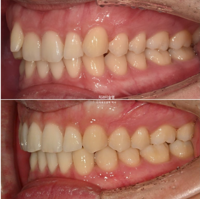 옥니 덧니 교정 왜소치 선천적 결손 3전치 무삭제 라미네이트 인비절라인 교정 관련 이미지 22
