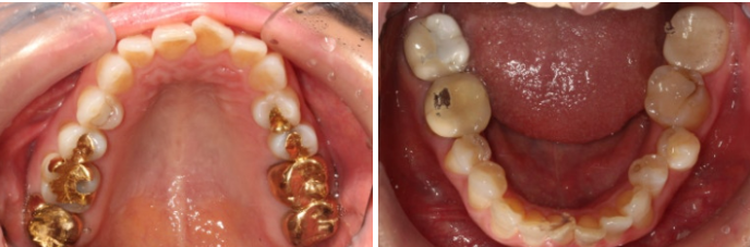 40대 후반 치아교정 해도 될까요? 관련 이미지 1