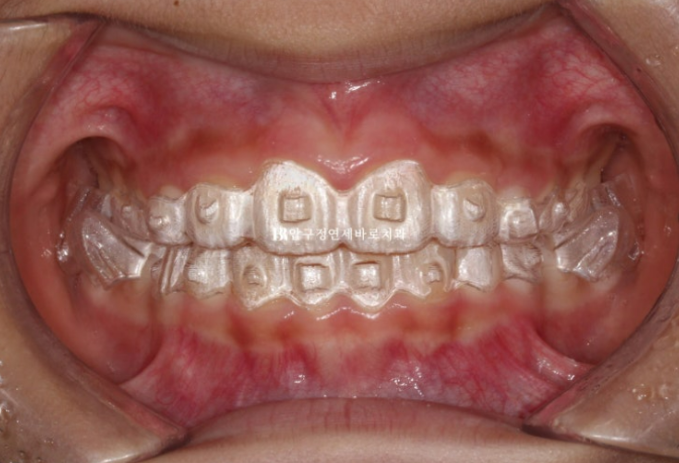 무턱교정 어린이 투명교정 인비절라인 퍼스트 교정 후기 관련 이미지 11