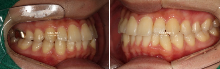 인비절라인 비발치 앞니 돌출 덧니 교정 ? 관련 이미지 3