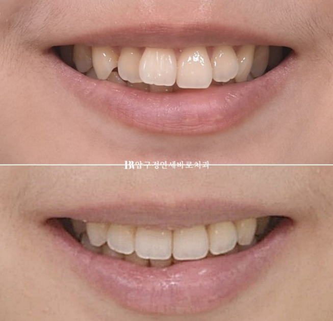 Orthodontic Treatment for International Students: Is Short-Term Treatment Possible in Korea? | A Real 5-Month Front Teeth Partial Orthodontic Case image 10