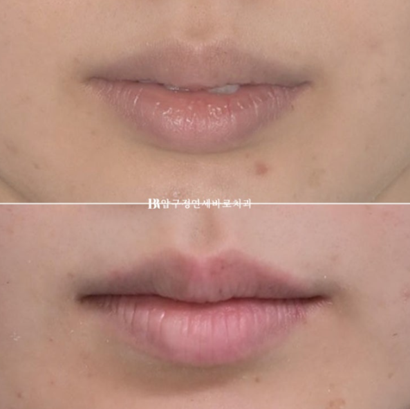 Gummy Smile Correction Review | Natural Improvement of Gummy Smile and Buccal Corridors Through Extraction Treatment for Protruding Teeth image 15
