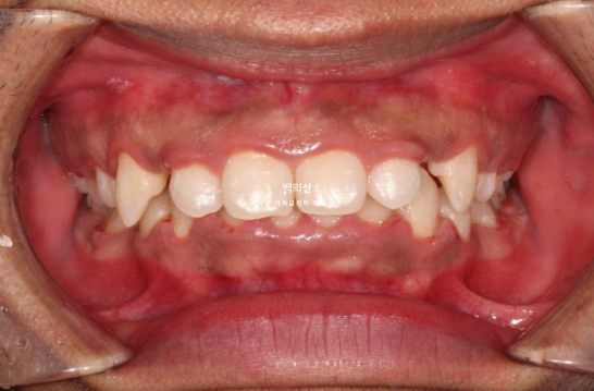 거미스마일 잇몸미소 발치 돌출입 과개교합 교정 후기 관련 이미지 2
