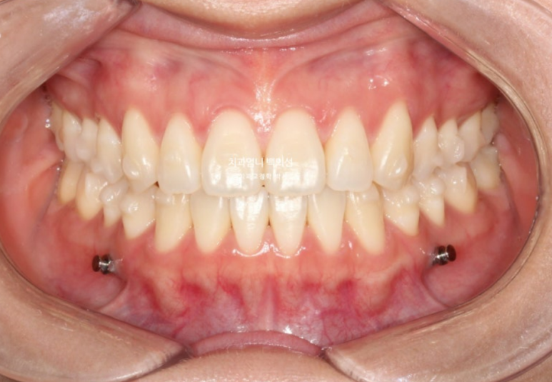 인비절라인 개방교합 교정 어금니 함입 교정 비베라? 관련 이미지 4