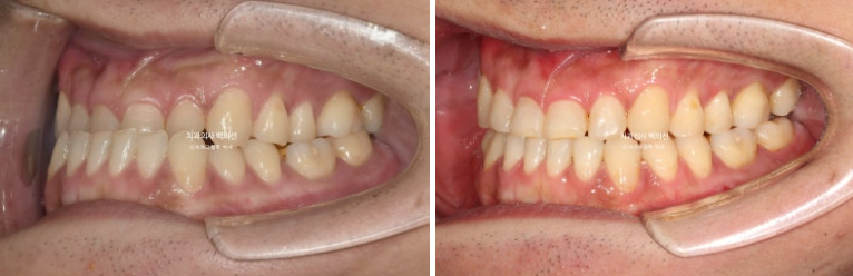 30대 주걱턱 비수술 비발치 교정 후기 관련 이미지 10