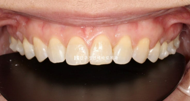 벌어진 치아 교정 인비절라인 라이트 무삭제 라미네이트 치료 관련 이미지 15
