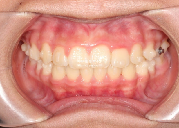 덧니 반대교합 과개교합 인비절라인 퍼스트 악궁확장 어린이 교정 관련 이미지 9