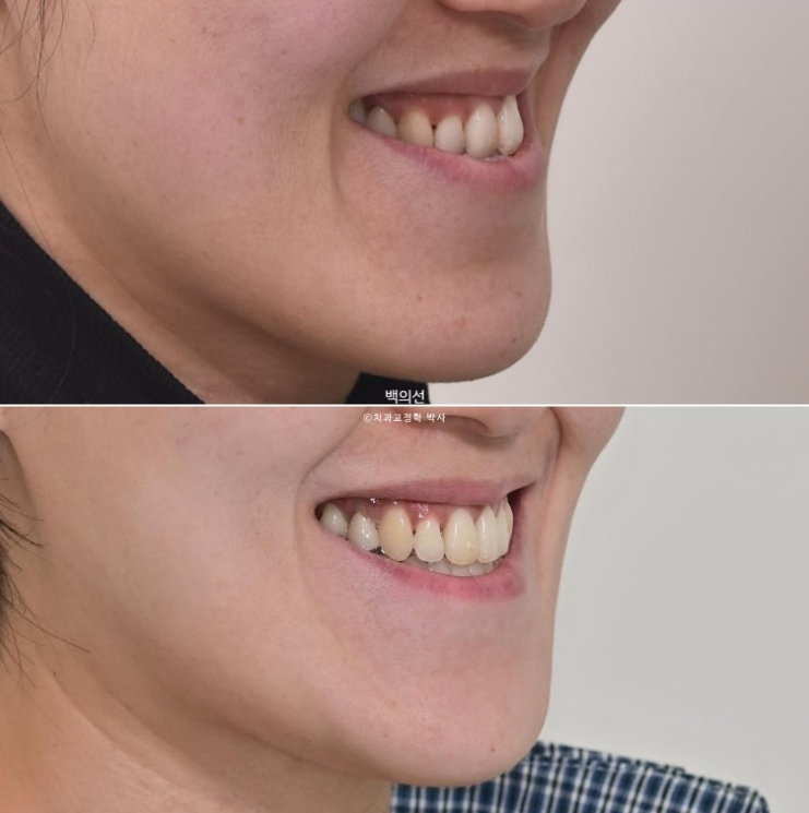 30대 비수술 비발치 주걱턱 부정교합 인비절라인 교정 관련 이미지 16