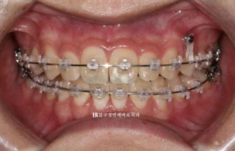 옥니교정 / 웃을때 아랫니만 보여요. 앞니 노출도 교정? 관련 이미지 5