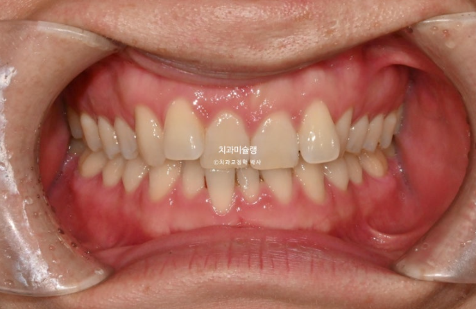 덧니 앞니 부분교정 급속교정 단기 MTA 미니튜브 기간 6개월 관련 이미지 2