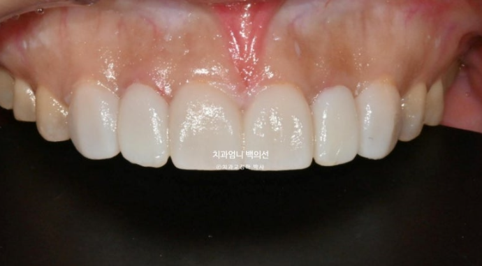 비수술 개방교합 클리피씨 30대 무삭제 라미네이트 치료기간 2년 관련 이미지 10