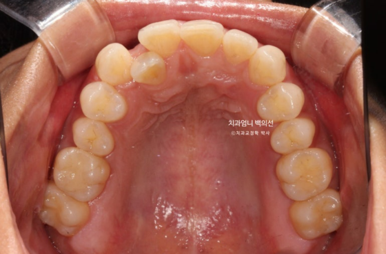 인비절라인 비발치 덧니 교정 반대교합 치료 후기 관련 이미지 4