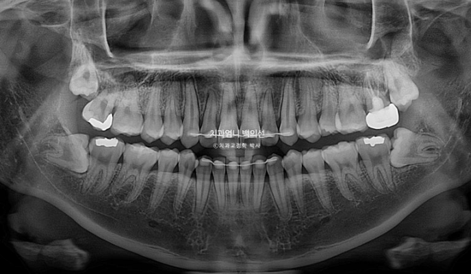 앞니 부분 교정 토끼이빨 덧니교정 ? 관련 이미지 20