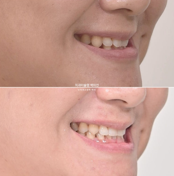 해외거주 앞니 선천적 결손 과개교합 인비절라인 라이트 브릿지 치료 관련 이미지 20