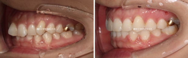 웃을 때 잇몸이 보여요. 잇몸미소 거미스마일 교정하기 관련 이미지 8
