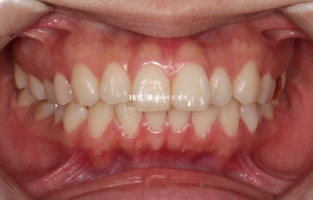 Gummy Smile Correction Review | Natural Improvement of Gummy Smile and Buccal Corridors Through Extraction Treatment for Protruding Teeth image 2