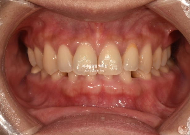 해외거주 앞니 선천적 결손 과개교합 인비절라인 라이트 브릿지 치료 관련 이미지 2