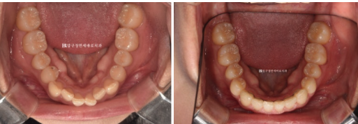앞니 부분교정은 어떤 경우에 가능한가요? 단기 앞니 부분교정 왜소치 치료 무삭제 라미네이트 관련 이미지 11