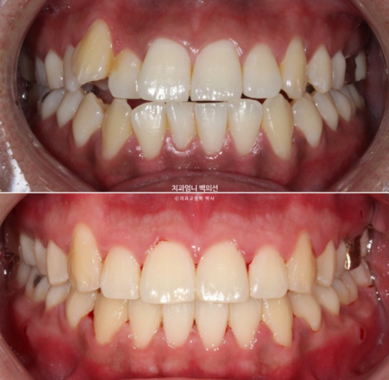 반대교합 비발치 교정 클리피씨 후기 관련 이미지 9