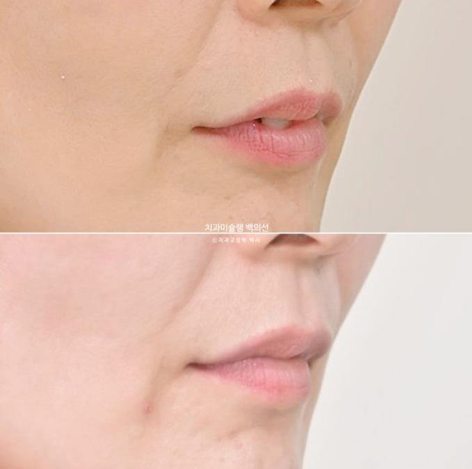 50대 치아교정 중년 발치교정 블랙트라이앵글 치료 후기 관련 이미지 23