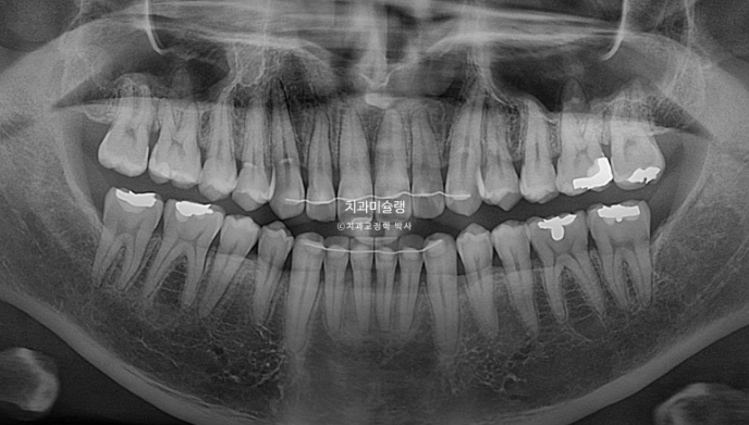 30대 MSE 악궁확장 덧니 반대교합 비발치 클리피씨 부작용 관련 이미지 21