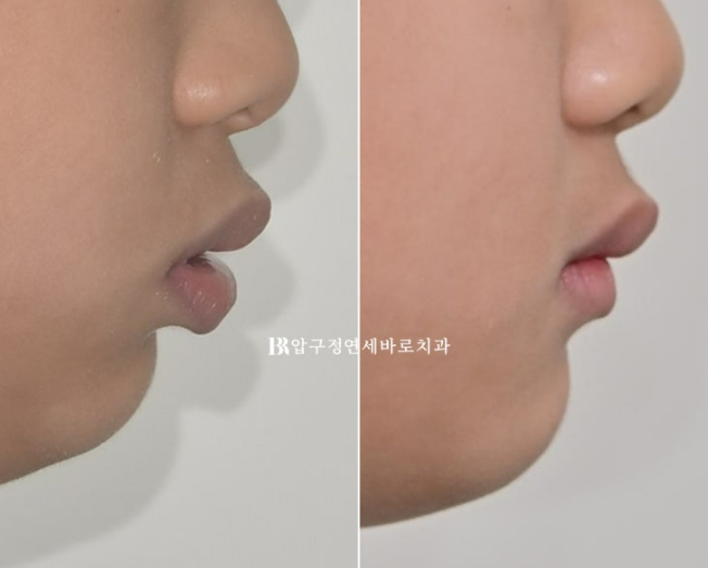 인비절라인 퍼스트 소아교정, 영구치 교정까지 한 번에 가능할까요? 관련 이미지 21