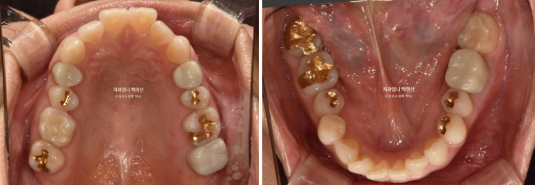 50대 캔팅 교합평면 기울어짐 덧니 교정 인비절라인 라이트 교정? 관련 이미지 4