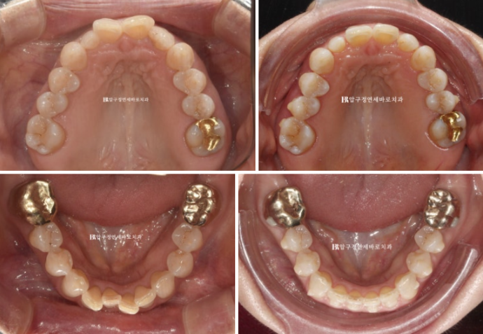 Can It Be Done in Your 50s? Real Results from Limited Front Teeth Orthodontics + No-Prep Laminate Veneers Revealed image 10