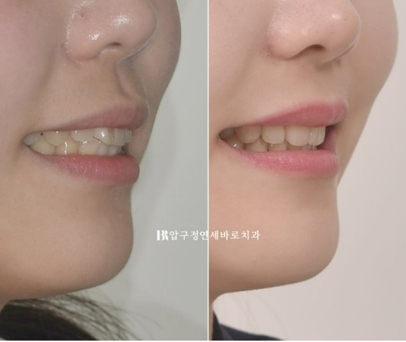 돌출입 교정 후 입매 변화, 과하지 않게 자연스럽게 관련 이미지 16
