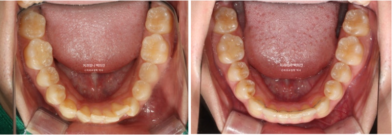 인비절라인 비발치 앞니 돌출 교정 치료기간 2년 5개월 관련 이미지 16