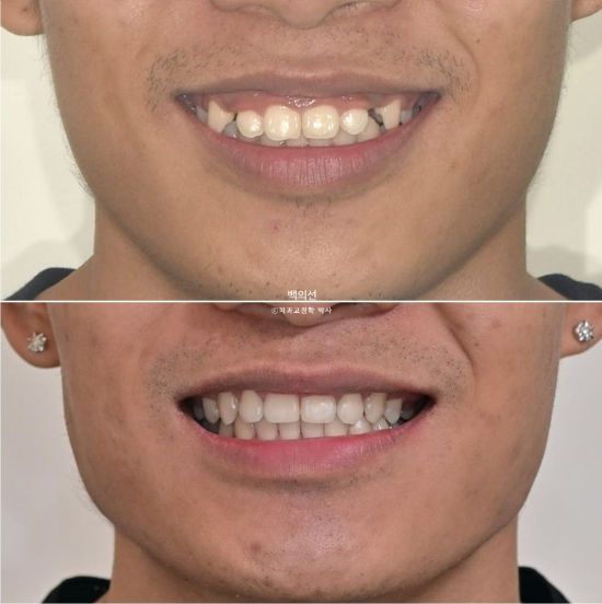거미스마일 잇몸미소 발치 돌출입 과개교합 교정 후기 관련 이미지 14