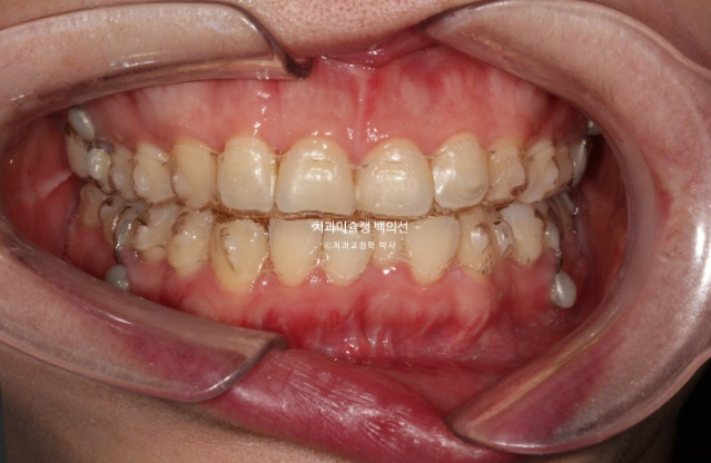 비발치 덧니 교정 인비절라인 과개교합 교정 무삭제 라미네이트 치료 후기 관련 이미지 6