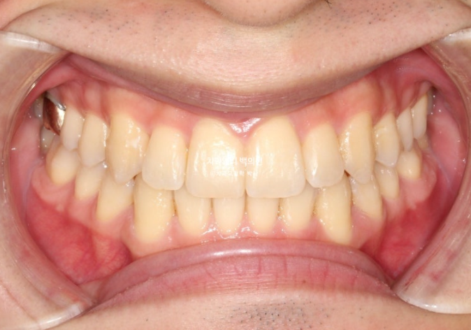 인비절라인 비발치 앞니 돌출 덧니 교정 ? 관련 이미지 9