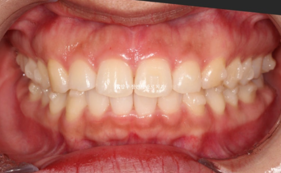 돌출입 교정 치아 벌어짐 인비절라인 투명교정 치료 관련 이미지 5