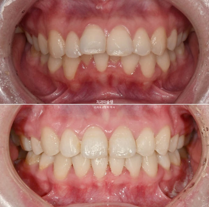심한 돌출입 입술부전증 호두주름 발치교정 치료 관련 이미지 14