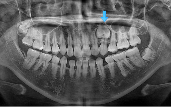 돌출입 교정 인비절라인 발치 교정 개방교합 치료 후기 관련 이미지 5