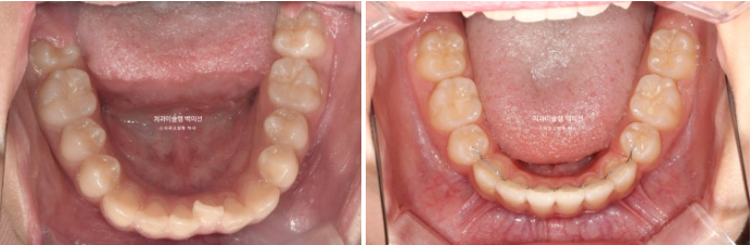 돌출입 무턱 인비절라인 발치교정 덧니 치료기간 1년 11개월 관련 이미지 13