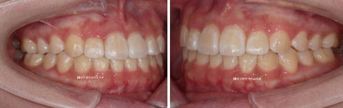 서울 인비절라인 치과 재교정 뻐드렁니 교정 관련 이미지 5