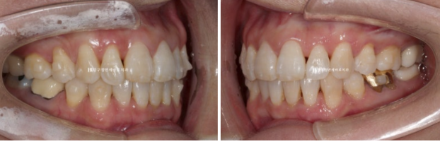 Can Invisalign Lite Work for People in Their 50s? A Real Middle-Aged Orthodontic Case Improving Butterfly Teeth and Gum Recession image 7