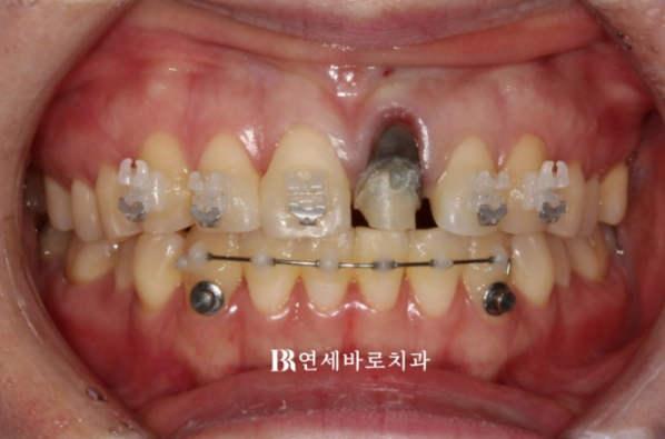 임플란트 없이 자연치아 살리기 앞니 부분교정 보철교정 관련 이미지 3